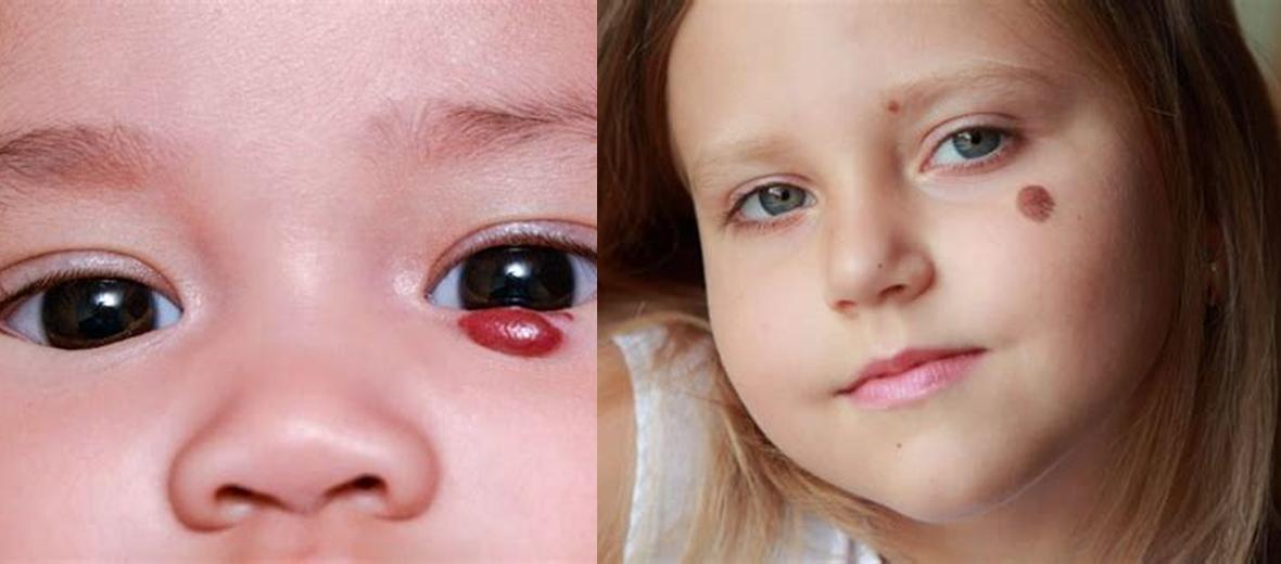 Quelle est la signification spirituelle des taches de naissance? Découvrez l'interprétation et l Quelle est la signification spirituelle des taches de naissance? Découvrez l'interprétation et l